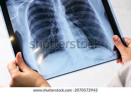 Woman hands with blue medical x-ray of chest scan on light background. Covid desease, cancer examination, pneumonia, asthma and tuberculosis diagnostic concept
