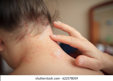 Woman Hands Lubricate Damaged Skin On The Neck By Healing Ointment