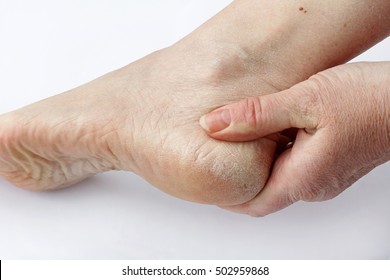 A woman has dry skin and cornea on her feet