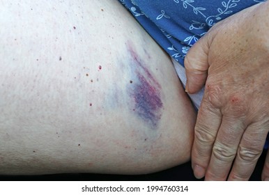 A Woman Has A Large Painful Bruise (bruise) On Her Inner Thigh