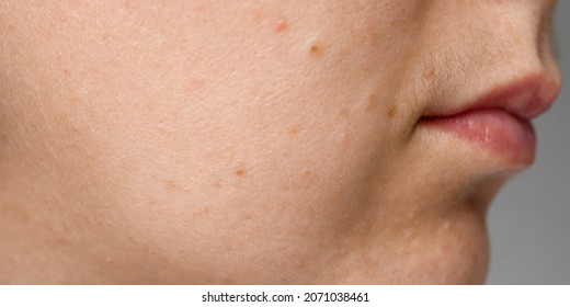 The Woman Has A Mustache Above Her Upper Lip, Close-up Of Black Facial Hair. Health Problem, Improper Care.