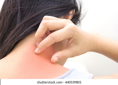 Woman Has Skin Rash Itch On Neck And Scratch Itching By Hand 