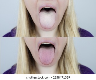 Woman has a white tongue. Painful white coating on the mucous membrane of the tongue. Diseases of the gastrointestinal tract, liver and gallbladder. The consequences of taking antibiotics. - Shutterstock ID 2258471359
