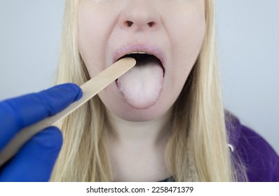 Woman has a white tongue. Painful white coating on the mucous membrane of the tongue. Diseases of the gastrointestinal tract, liver and gallbladder. The consequences of taking antibiotics. - Shutterstock ID 2258471379
