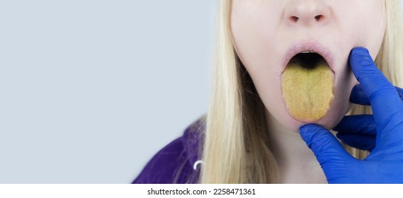 Woman has a yellow tongue. Painful yellow coating on the mucous membrane of the tongue. Diseases of the gastrointestinal tract, liver and gallbladder. The consequences of taking antibiotics. - Shutterstock ID 2258471361
