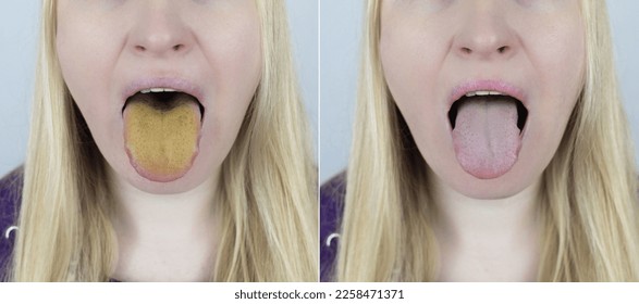Woman has a yellow tongue. Painful yellow coating on the mucous membrane of the tongue. Diseases of the gastrointestinal tract, liver and gallbladder. The consequences of taking antibiotics. - Shutterstock ID 2258471371