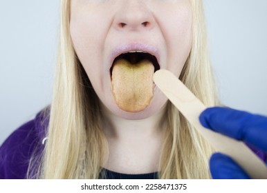 Woman has a yellow tongue. Painful yellow coating on the mucous membrane of the tongue. Diseases of the gastrointestinal tract, liver and gallbladder. The consequences of taking antibiotics. - Shutterstock ID 2258471375