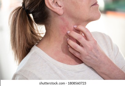 Woman Having Itchy And Scratching Her Neck. Allergy Symptoms