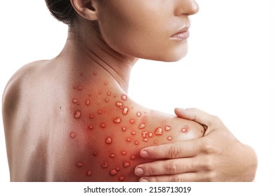 Woman and her skin affected by blistering rash because of monkeypox on white background - Shutterstock ID 2158713019
