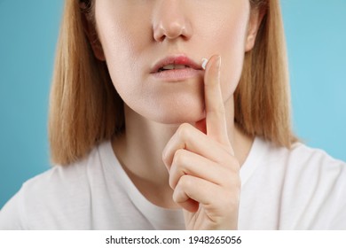 Woman With Herpes Applying Cream On Lips Against Light Blue Background, Closeup