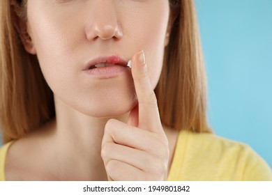 Woman With Herpes Applying Cream On Lips Against Light Blue Background, Closeup