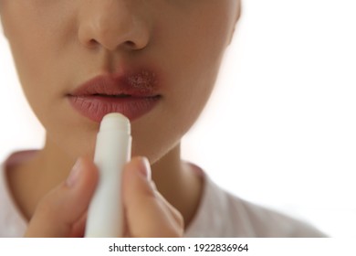 Woman with herpes applying lip balm against light background, closeup