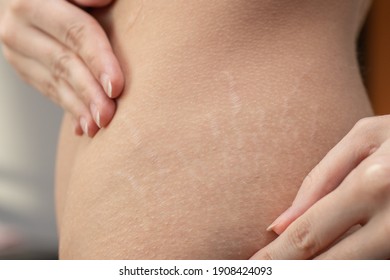 Woman hips with visible stretch marks. - Shutterstock ID 1908424093