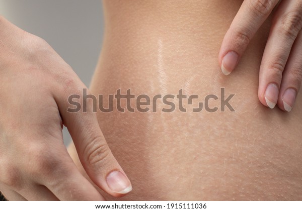 Woman hips with visible stretch marks.\
Young woman showing Stretch mark scars on her\
body.