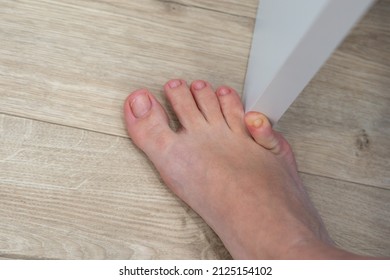 Woman Hit Furniture With The Little Toe. Incident At Home. Injury Of Foot Little Finger