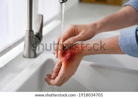Woman holding hand with burn under flowing water indoors, closeup