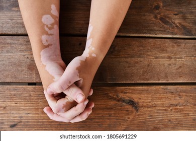 Woman holding hands together on a wooden background. she has skin disorder called vitiligo - white patches caused by loss of pigmentation. - Shutterstock ID 1805691229