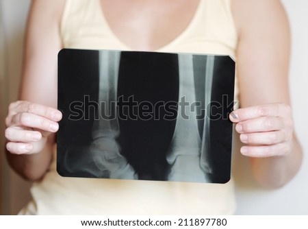 Woman holding an x-ray image of legs