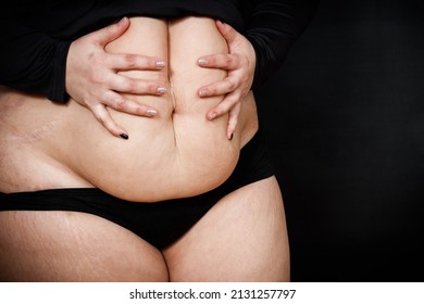 A Woman Holds Her Hands On A Fat Belly On A Black Background. Obese Person. High Quality Photo