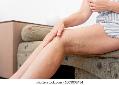 Woman at home with varicose veins. Healthcare problem, thrombophlebitis issue.