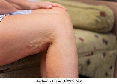 Woman At Home With Varicose Veins. Healthcare Problem, Thrombophlebitis Issue.