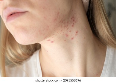 Woman with inflamed cystic acne on her neck and jawline area. Selective focus.  - Shutterstock ID 2095558696