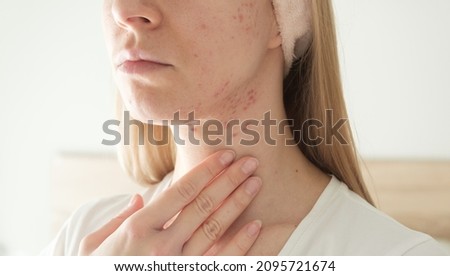 Woman with inflamed cystic acne on her neck and jawline area. Selective focus. 