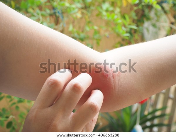 Woman Itchy Skin Insect Bited Stock Photo Edit Now