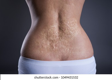 Woman and large scar after burn the back  rear view gray background