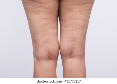 Woman Leg With Cellulite.