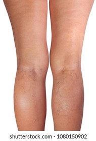 Woman legs with varicose veins,  isolated on white - Shutterstock ID 1080150902