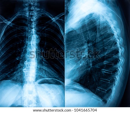 Woman Lumbar Spine X-ray, Back Examination