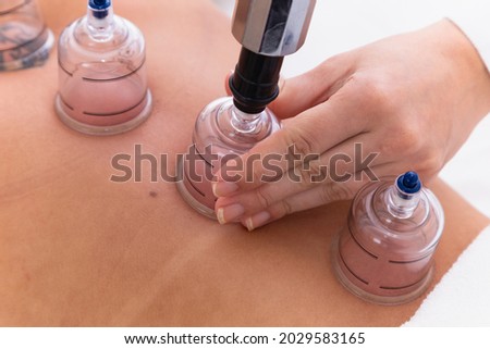 Woman lying on her chest with cupping treatment on her back. woman doing sucker