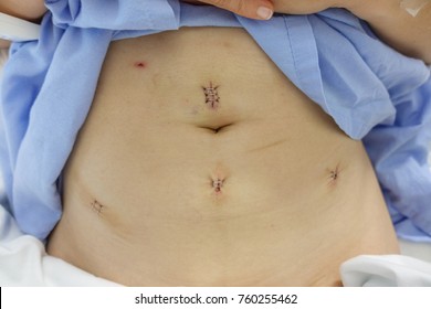 Myomectomy Hd Stock Images Shutterstock