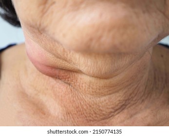 Woman Neck Lymph Node Inflammation. Closeup Photo, Blurred.