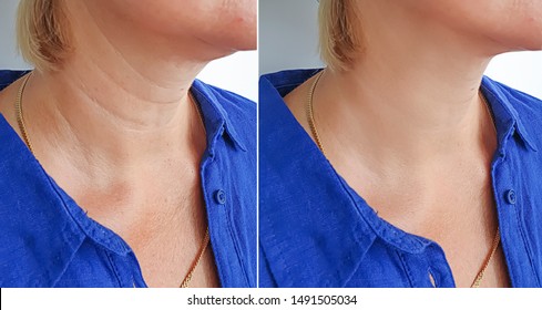 woman neck wrinkles   after treatment