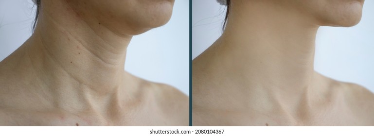 woman neck wrinkles before and after