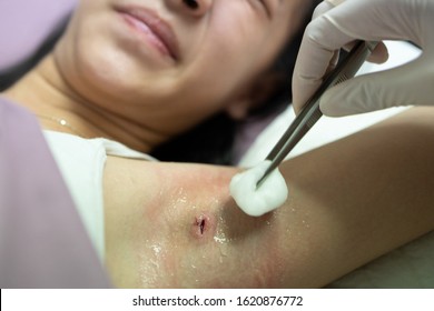 Woman Nurse With Gloves Using Tweezers,cotton Wool,cleans It With Antiseptic Or Normal Saline Solution,cleaning The Wound On The Armpit,asian Child Girl With Surgical Wounds Feel Irritated,painful