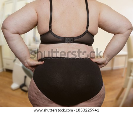 Woman with obesity and cellulite in a treatment room with a doctor