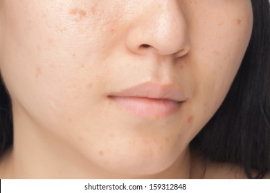 Woman with oily skin and acne scars - Shutterstock ID 159312848