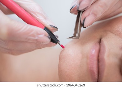 Woman On Electro Epilation Of The Face. Hardware Permanent Removal Of Unwanted Hair On The Chin