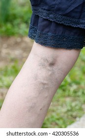 Woman with painful varicose and spider veins on her legs. Vascular disease, varicose veins problems, painful unaesthetic medical condition concept.