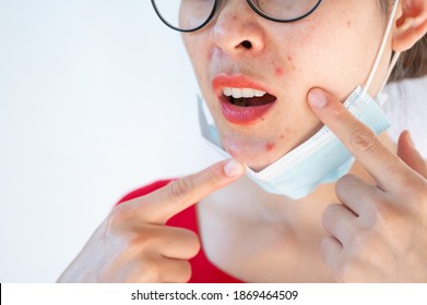 Woman Pointing Acne Inflamed Occur On Her Face After Wearing Mask For Long Time During Covid-19 Pandemic. Wearing Mask For Prolonged Periods Can Damage The Skin.