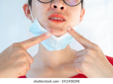 Woman Pointing Acne Inflamed Occur On Her Face After Wearing Mask For Long Time During Covid-19 Pandemic. Wearing Mask For Prolonged Periods Can Damage The Skin.