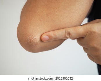 Woman pointing at rough elbows and dry skin. body skincare concept. 