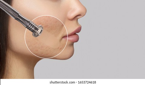 Woman with problem skin.The cosmetologist makes the procedure Microdermabrasion of the face skin of a beautiful woman in a beauty salon.Cosmetology and professional skin care.