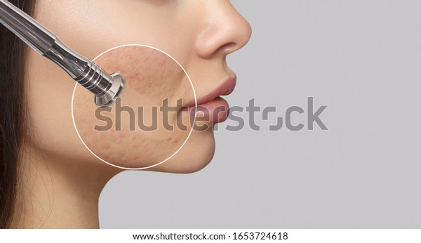 Woman with\
problem skin.The cosmetologist makes the procedure\
Microdermabrasion of the face skin of a beautiful woman in a beauty\
salon.Cosmetology and professional skin\
care.