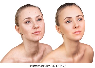 Woman with problem skin on her face