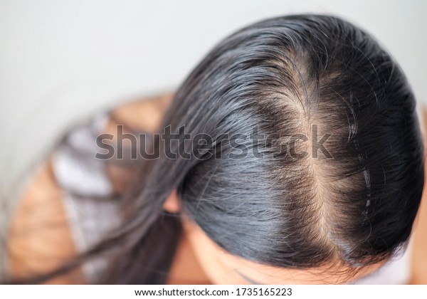 Woman with problem thin\
hair.