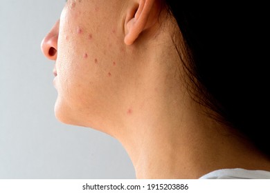 Woman With Problematic Skin And Acne, Closeup